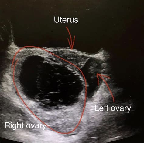 best test for ovarian torsion|ovarian torsion recovery time.